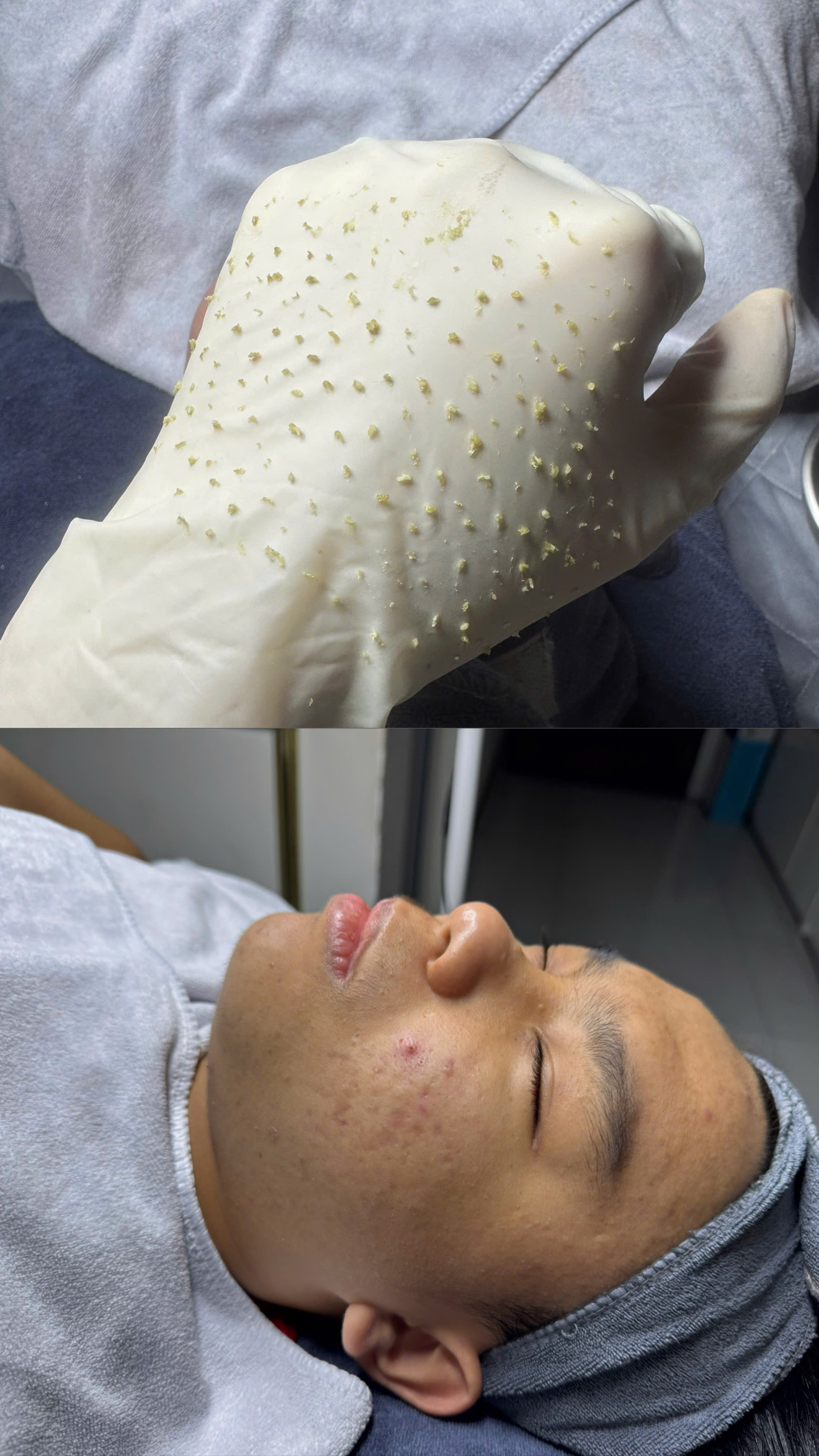 Nặn Mụn Chuẩn Y Khoa 299K: Giải Pháp An Toàn Cho Làn Da Sạch Mụn!
