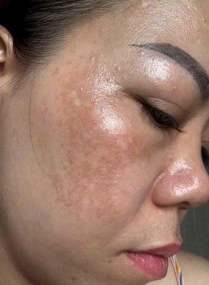 Đừng Để Đốm Nám Nâu Che Mờ Vẻ Đẹp: Lấy Lại Làn Da Rạng Rỡ Ngay Hôm Nay!