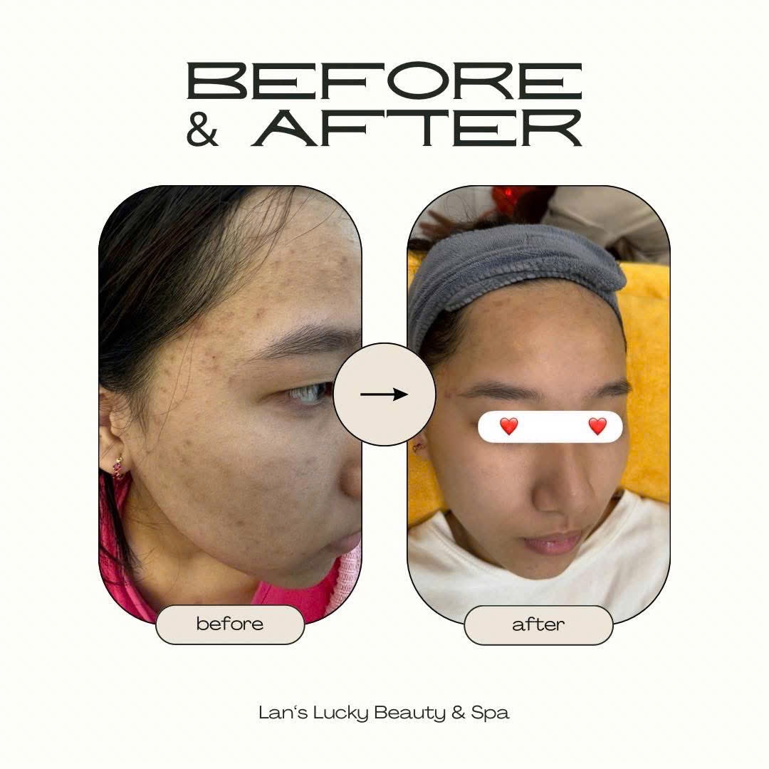 Lan'Lucky Spa: Liệu Trình Trị Mụn Chuyên Sâu Chỉ 299K – Hết Lo Mụn, Sáng Da!