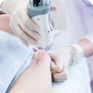 Liệu pháp trị Sẹo Rỗ